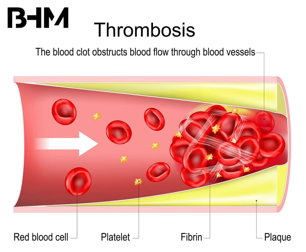thrombosis. The blood clot obstructs blood flow through blood vessels. Cross section of blood vessel with atherosclerotic plaque, Red blood cells, Platelets and Fibrin. vector illustration